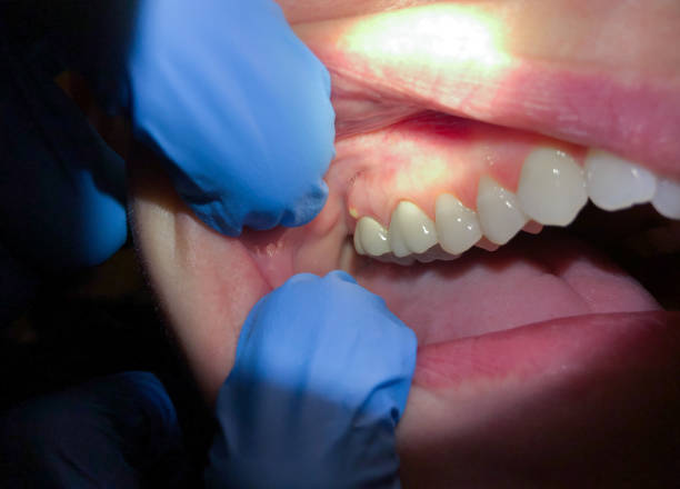 Best Cracked Tooth Emergency Dentist  in Colusa, CA